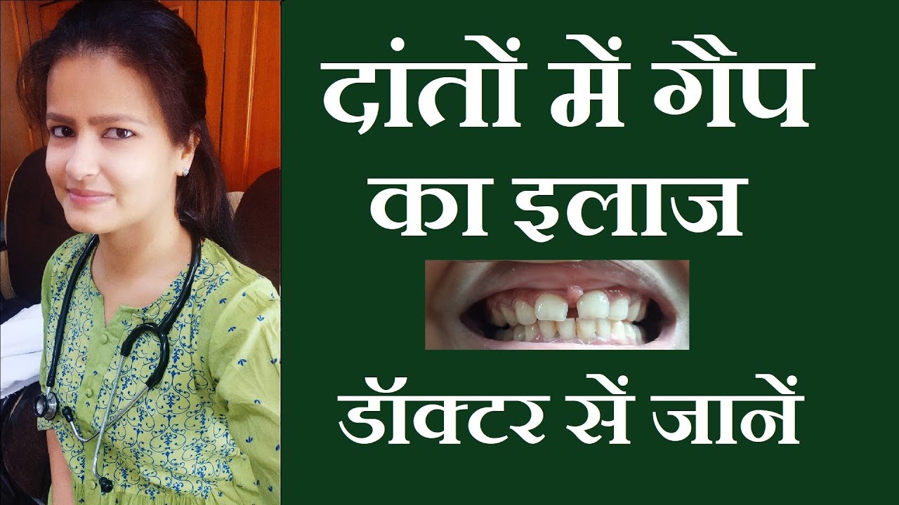 दांतों में गैप का इलाज | danto me gap ka ilaj | Midline Diastema