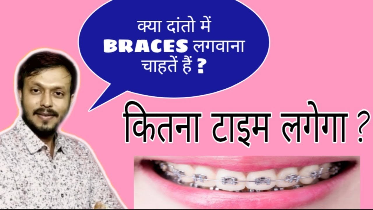 How much time for braces treatment| when you get result by dental braces