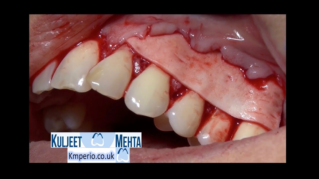 Treatment of Gum Recession with Alloderm.