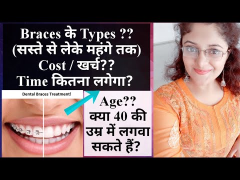 Dental Braces Treatment- Cost |Types Of Braces |Time |Age For Braces|Dental Orthodontic Treatment!!