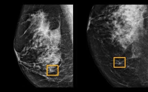 AI model improves breast cancer detection on mammograms